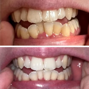 Teeth Whitening Powder – Anti-Stain Polisher for Discolored Teeth